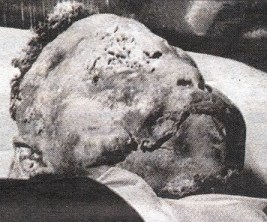 Emmett Till